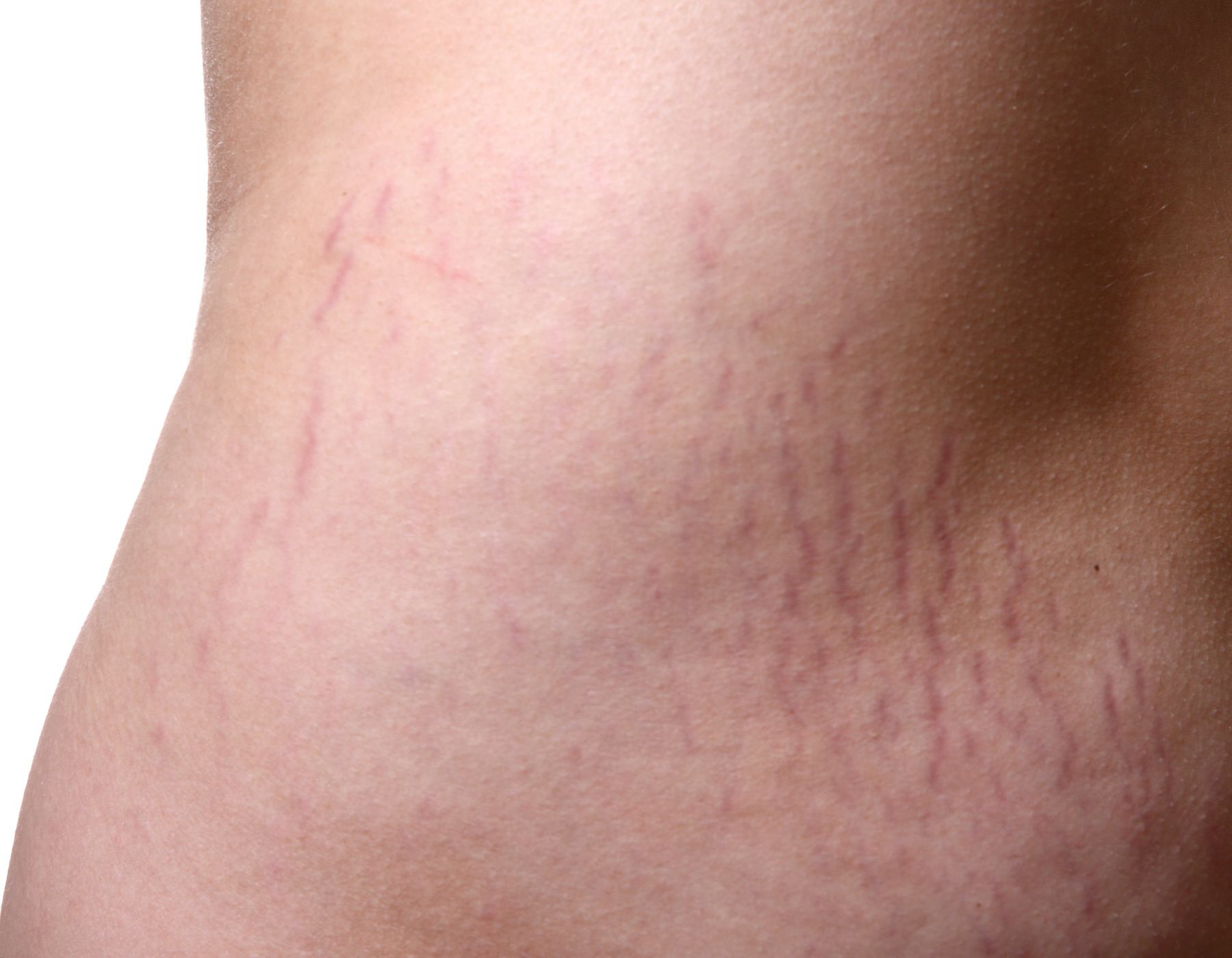 Estrías: Tratamientos y dietas de Clínica Rubigar Estrías: Tratamientos y dietas de Clínica Rubigar