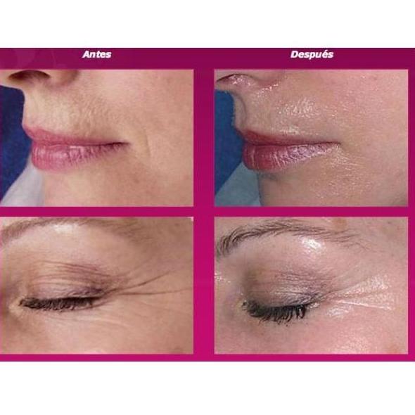 Rejuvenecimiento facial: Tratamientos de belleza de Centro Bienestar y Salud Cayma Rejuvenecimiento facial: Tratamientos de belleza de Centro Bienestar y Salud Cayma