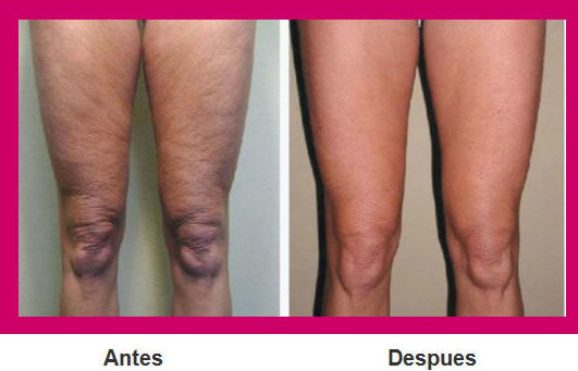 Piernas reafirmadas, Antequera Piernas reafirmadas, Antequera