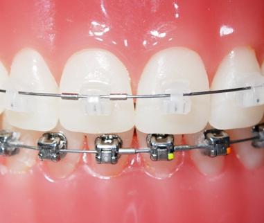 Ortodoncia sistema Damon. Brackets transparentes Ortodoncia sistema Damon. Brackets transparentes