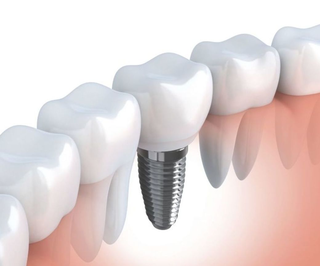 Implantes dentales: Servicios de Clínica Dental Dr. Esteve Padrós Implantes dentales: Servicios de Clínica Dental Dr. Esteve Padrós