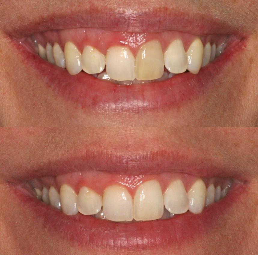 Blanqueamiento dental Blanqueamiento dental