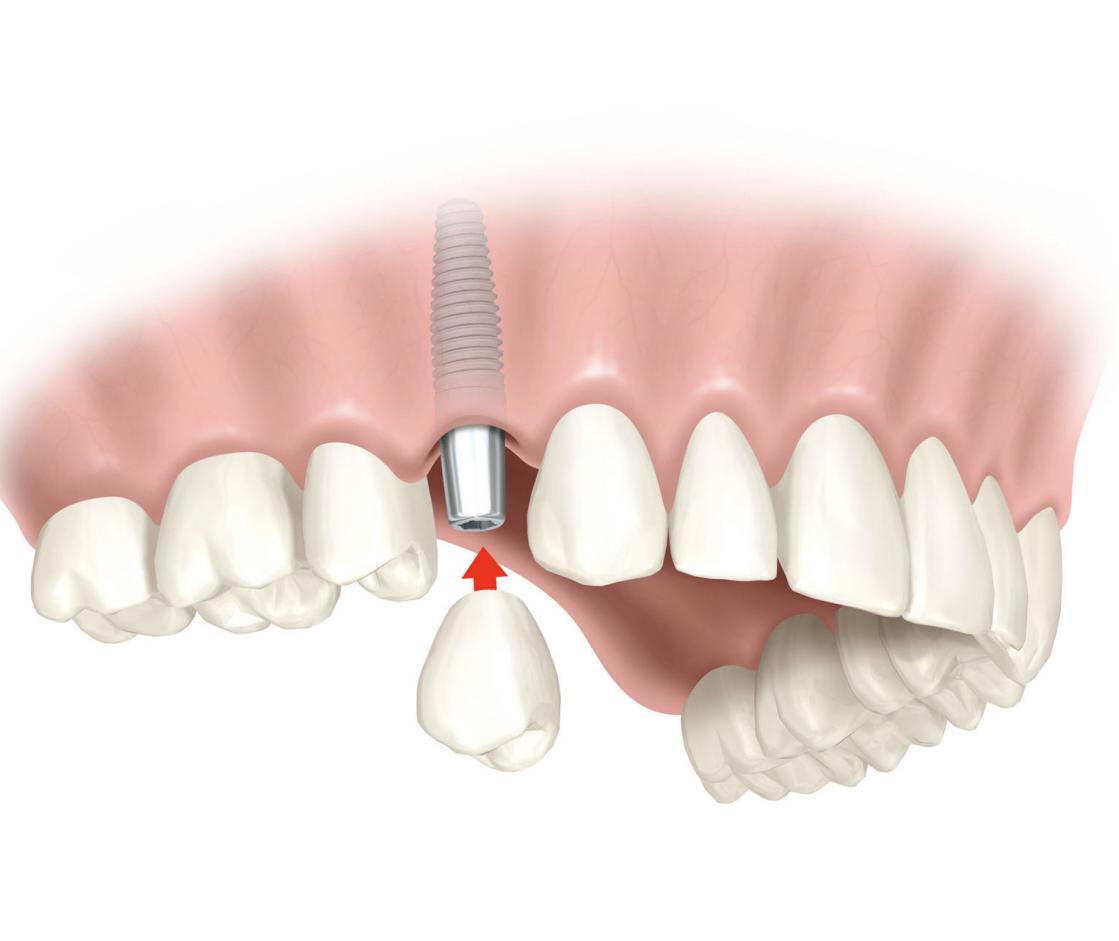 Implantes dentales Implantes dentales