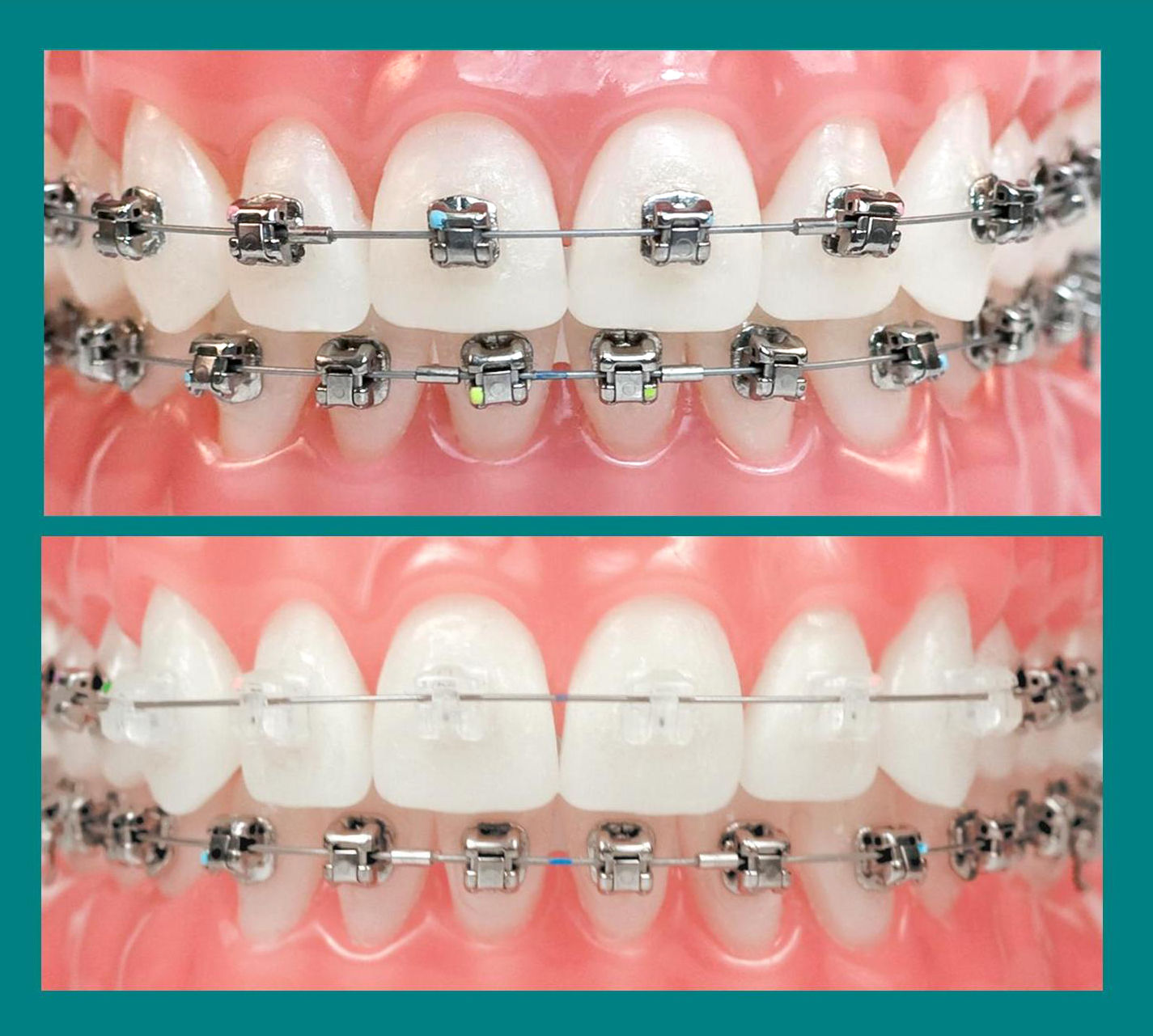 Ortodoncia sistema Damon. Brackets transparentes Ortodoncia sistema Damon. Brackets transparentes