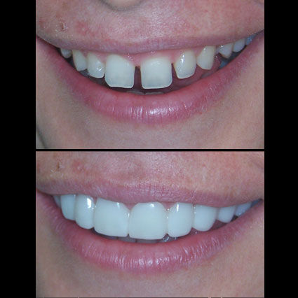 Snap on Smile Snap on Smile