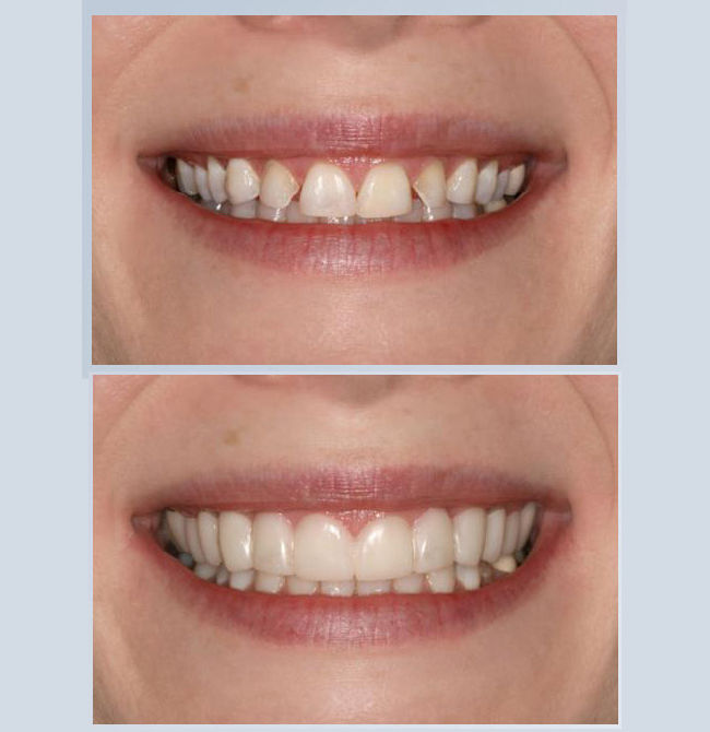 Snap on Smile Snap on Smile