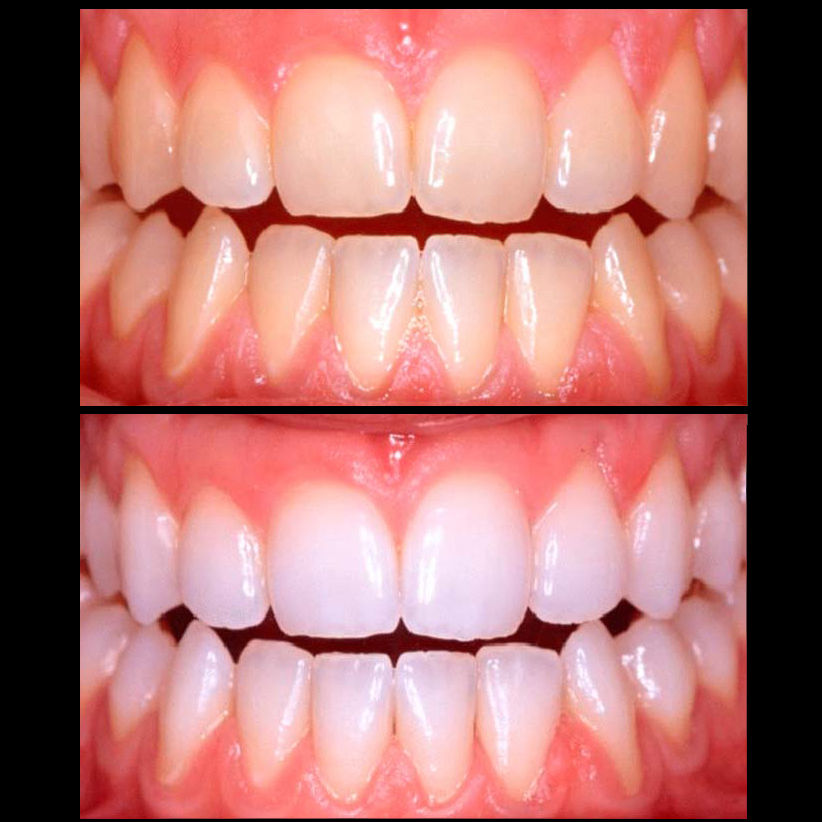 Blanqueamiento dental Blanqueamiento dental