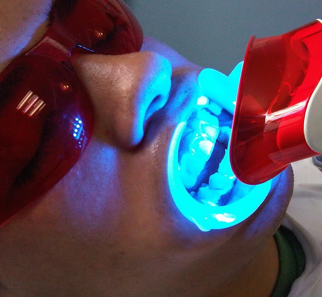 Blanqueamiento dental Blanqueamiento dental