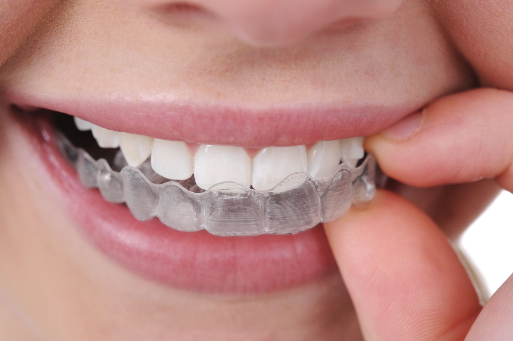 Ortodoncia invisible Invisalign Ortodoncia invisible Invisalign