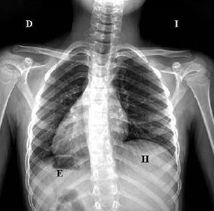 Escoliosis Escoliosis