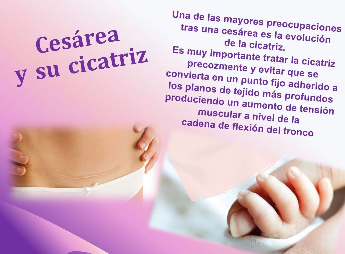 Cesárea y su cicatriz: Especialidades de Clínica Fisioterapia Maccari Sport Cesárea y su cicatriz: Especialidades de Clínica Fisioterapia Maccari Sport