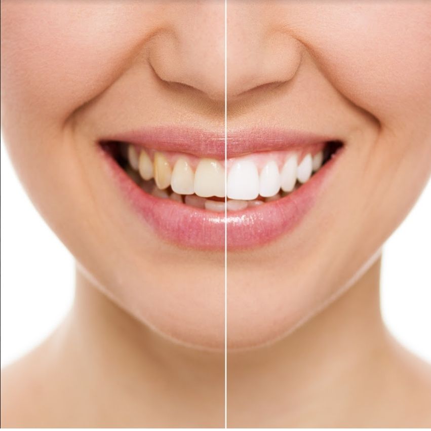 Blanqueamiento dental: Tratamientos de Azul Salón De Belleza Blanqueamiento dental: Tratamientos de Azul Salón De Belleza
