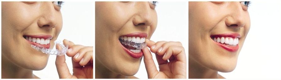 Invisalign 2 Invisalign 2