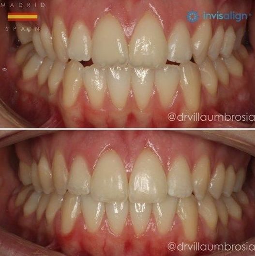Caso real invisalign Caso real invisalign