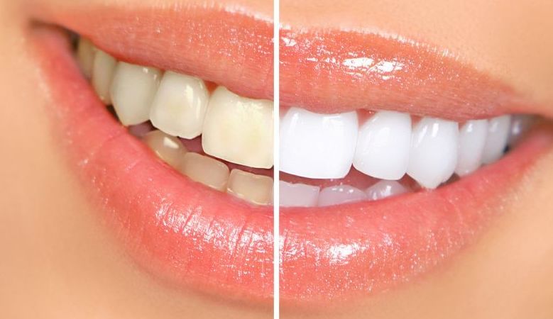 blanqueamiento dental blanqueamiento dental