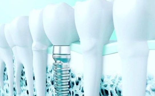 Implante dental Implante dental