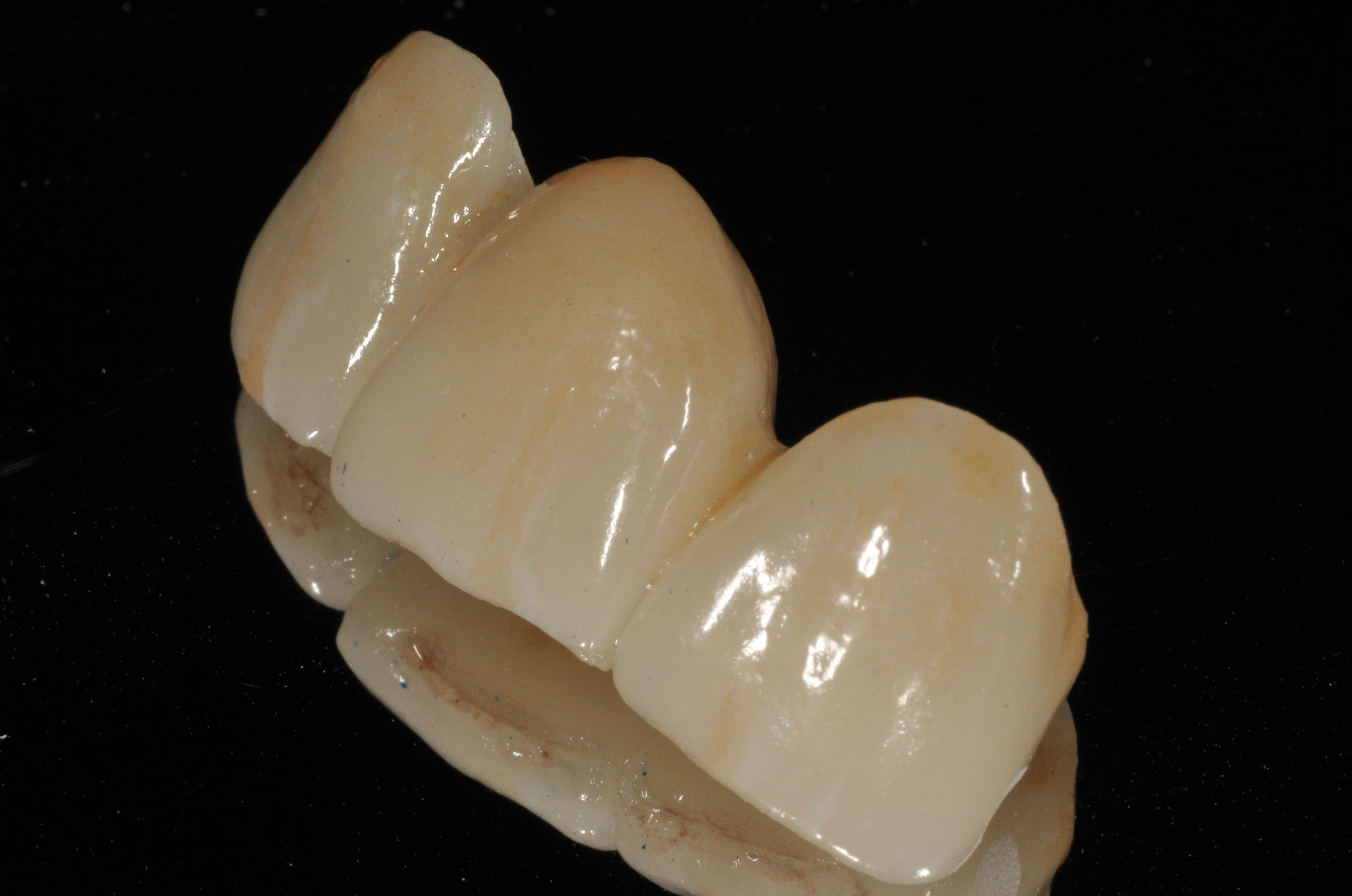 clínica dental en chamartín. Puente emax clínica dental en chamartín. Puente emax