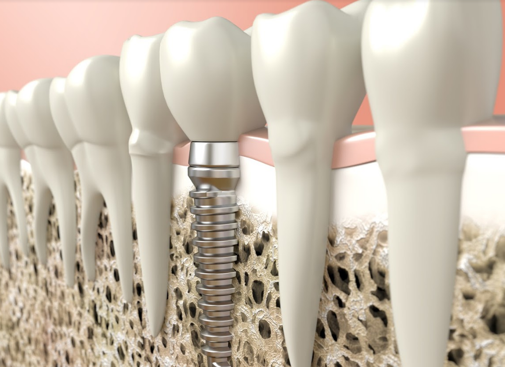 Implantes dentales: Tratamientos dentales de Clínica Dental Dres. Nuñez García Implantes dentales: Tratamientos dentales de Clínica Dental Dres. Nuñez García