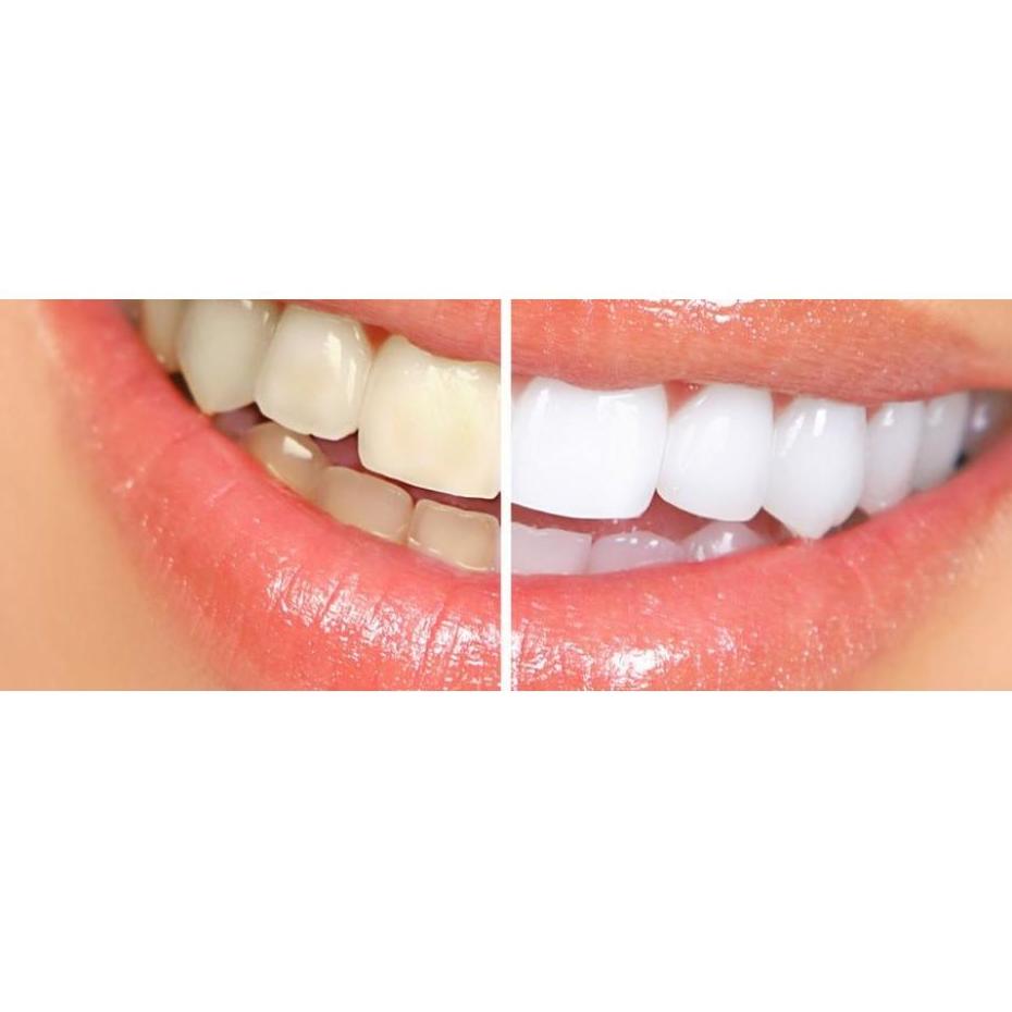 Blanqueamientos dentales: Tratamientos dentales de Clínica Dental Dres. Nuñez García Blanqueamientos dentales: Tratamientos dentales de Clínica Dental Dres. Nuñez García