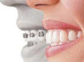 Ortodoncia invisible: Tratamientos dentales de Clínica Dental Dres. Nuñez García Ortodoncia invisible: Tratamientos dentales de Clínica Dental Dres. Nuñez García
