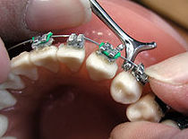 Bracketts: Tratamientos dentales de Clínica Dental Dres. Nuñez García Bracketts: Tratamientos dentales de Clínica Dental Dres. Nuñez García