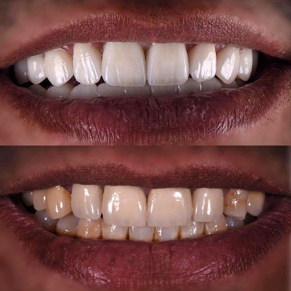 Blanqueamientos dentales: Tratamientos dentales de Clínica Dental Dres. Nuñez García Blanqueamientos dentales: Tratamientos dentales de Clínica Dental Dres. Nuñez García