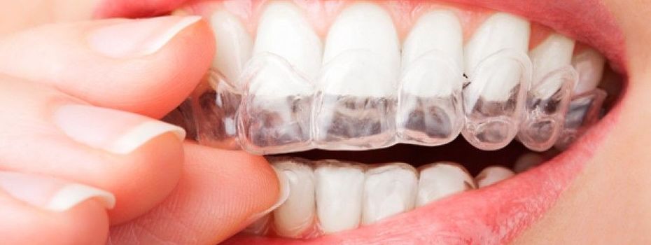 Ortodoncia invisible: Tratamientos dentales de Clínica Dental Dres. Nuñez García Ortodoncia invisible: Tratamientos dentales de Clínica Dental Dres. Nuñez García