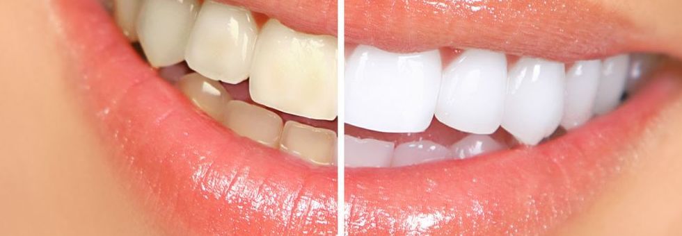 Estética dental blanqueamientos 