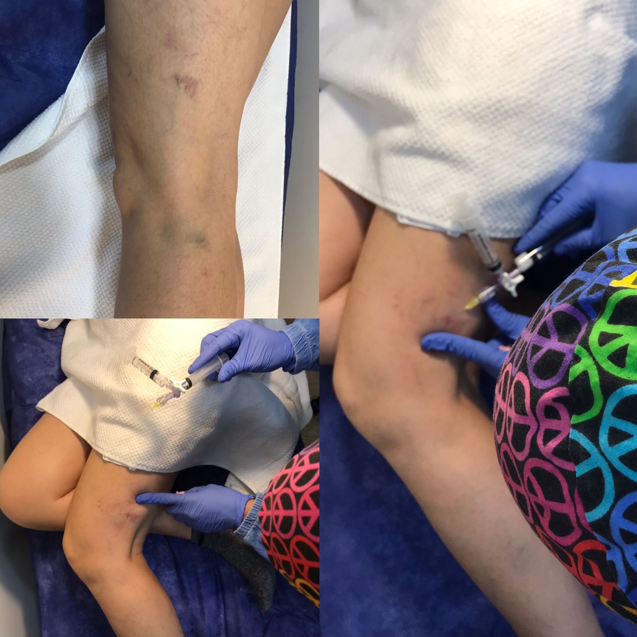 Esclerosis de varices Esclerosis de varices