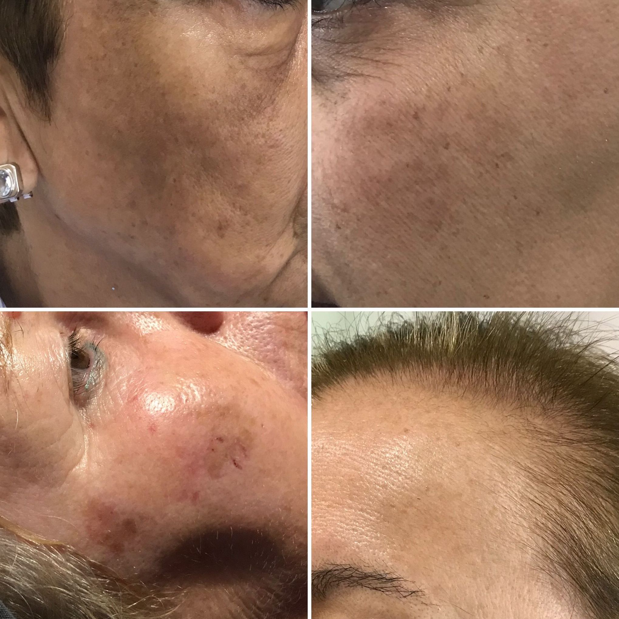TRATAMIENTO DE MANCHAS FACIALES: Servicios de IKIWELLNESS TRATAMIENTO DE MANCHAS FACIALES: Servicios de IKIWELLNESS