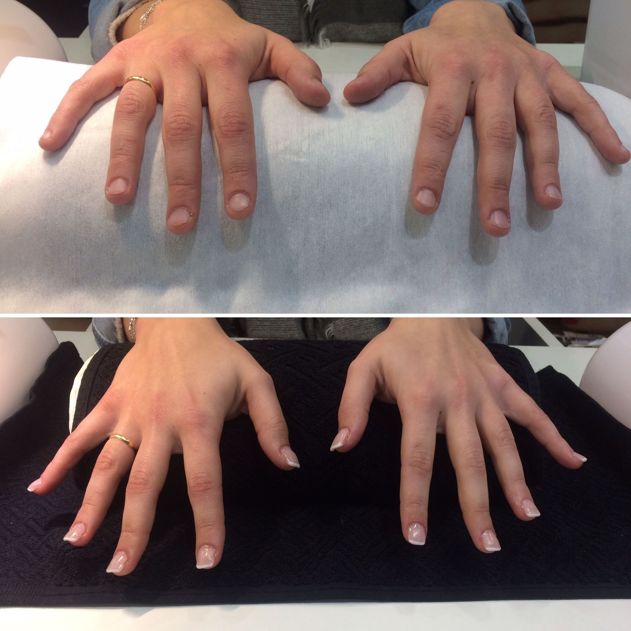 Tratamiento uñas mordidas Tratamiento uñas mordidas