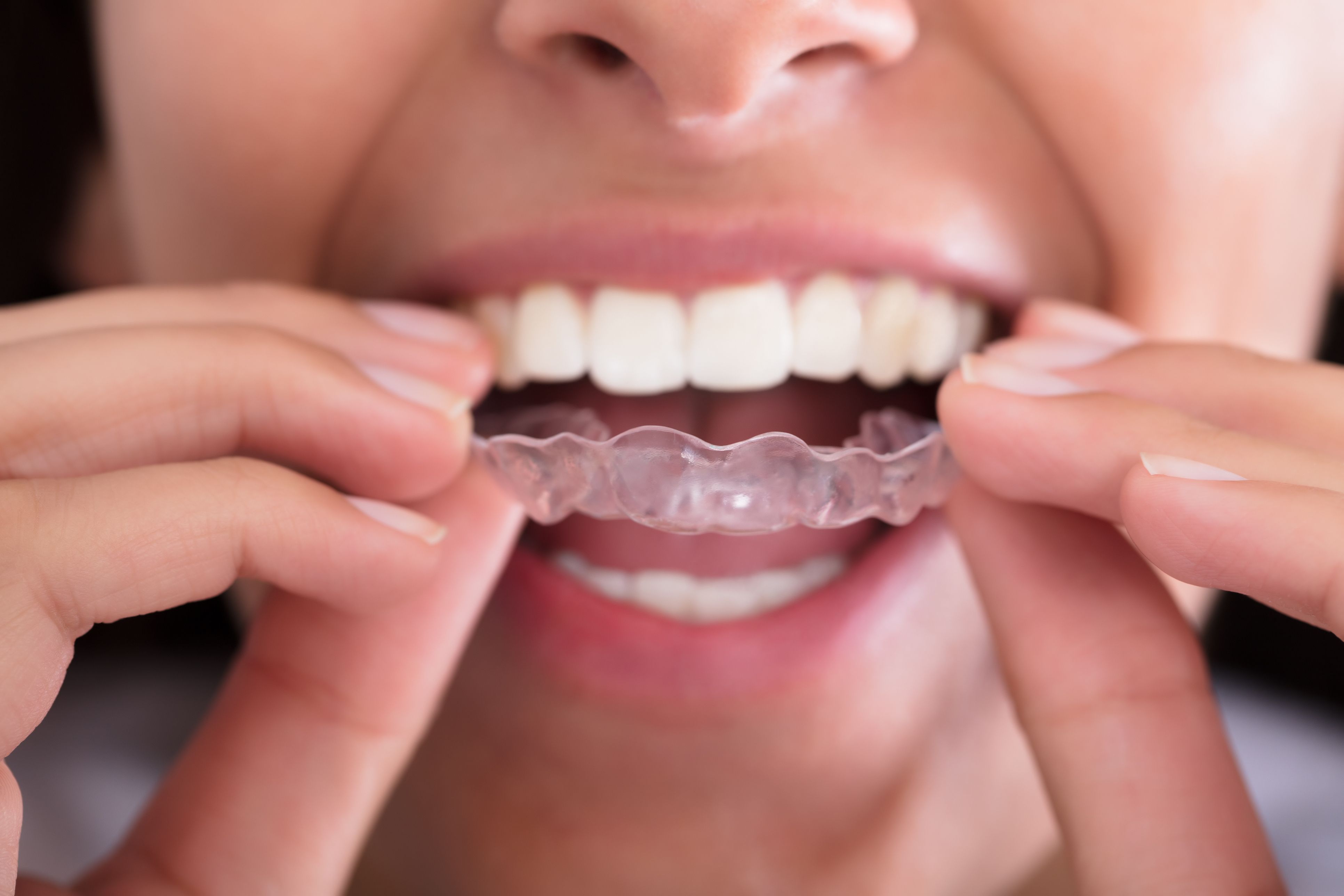 Ortodoncia: Tratamientos de Clínica Dental Santa Marta Ortodoncia: Tratamientos de Clínica Dental Santa Marta