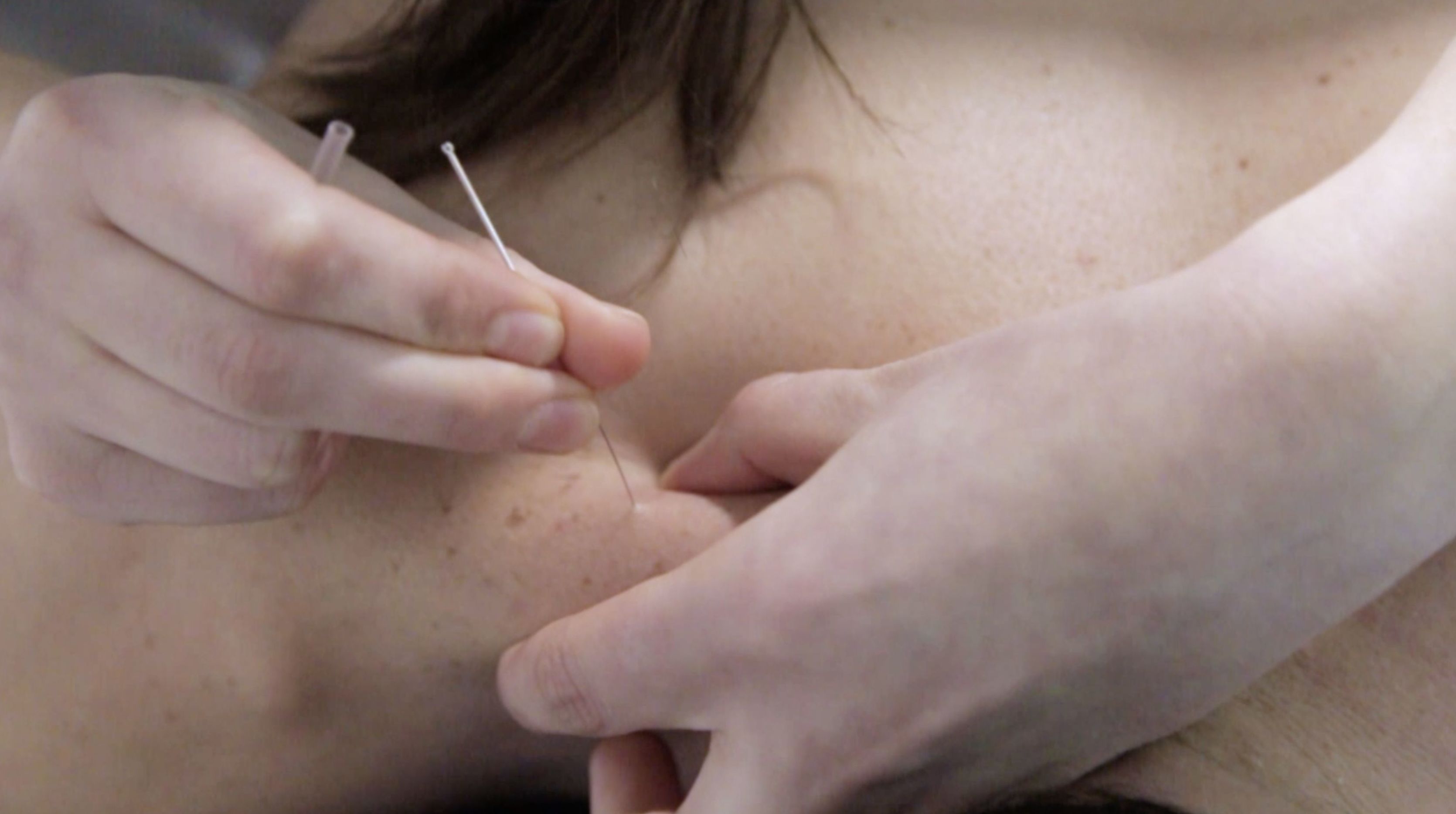 Fisioterapia: Punción Seca: Servicios de Clínica Tomás Ribera Fisioterapia: Punción Seca: Servicios de Clínica Tomás Ribera