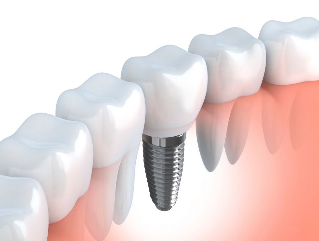 Prótesis: Servicios de CEO Clínica Dental Prótesis: Servicios de CEO Clínica Dental