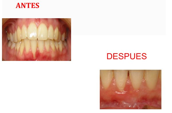 Injerto de tejido conectivo: Tratamientos de Centro Odontológico La Eliana Injerto de tejido conectivo: Tratamientos de Centro Odontológico La Eliana