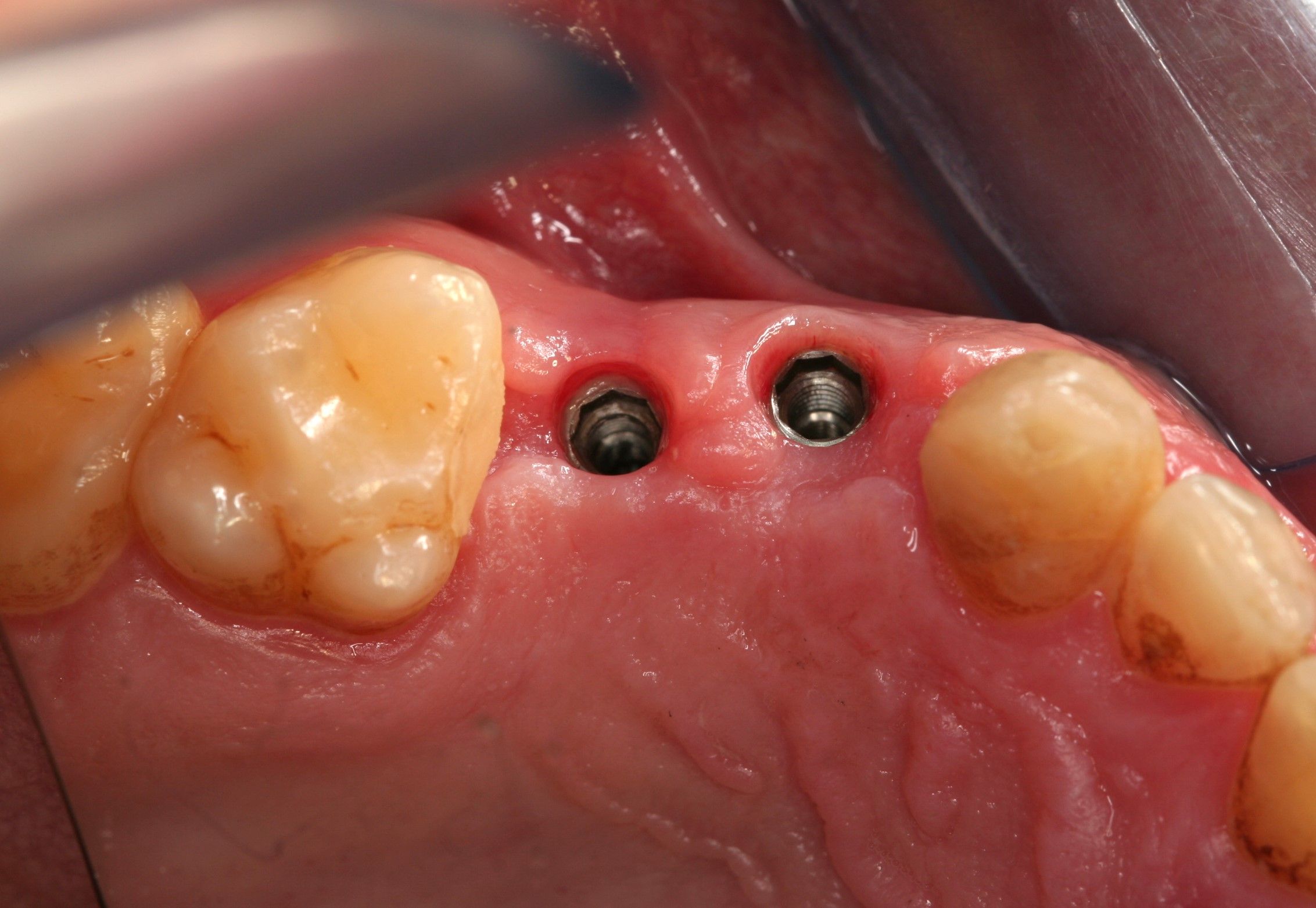 Implantes: Tratamientos de Centro Odontológico La Eliana Implantes: Tratamientos de Centro Odontológico La Eliana