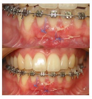 Injerto de tejido conectivo: Tratamientos de Centro Odontológico La Eliana Injerto de tejido conectivo: Tratamientos de Centro Odontológico La Eliana