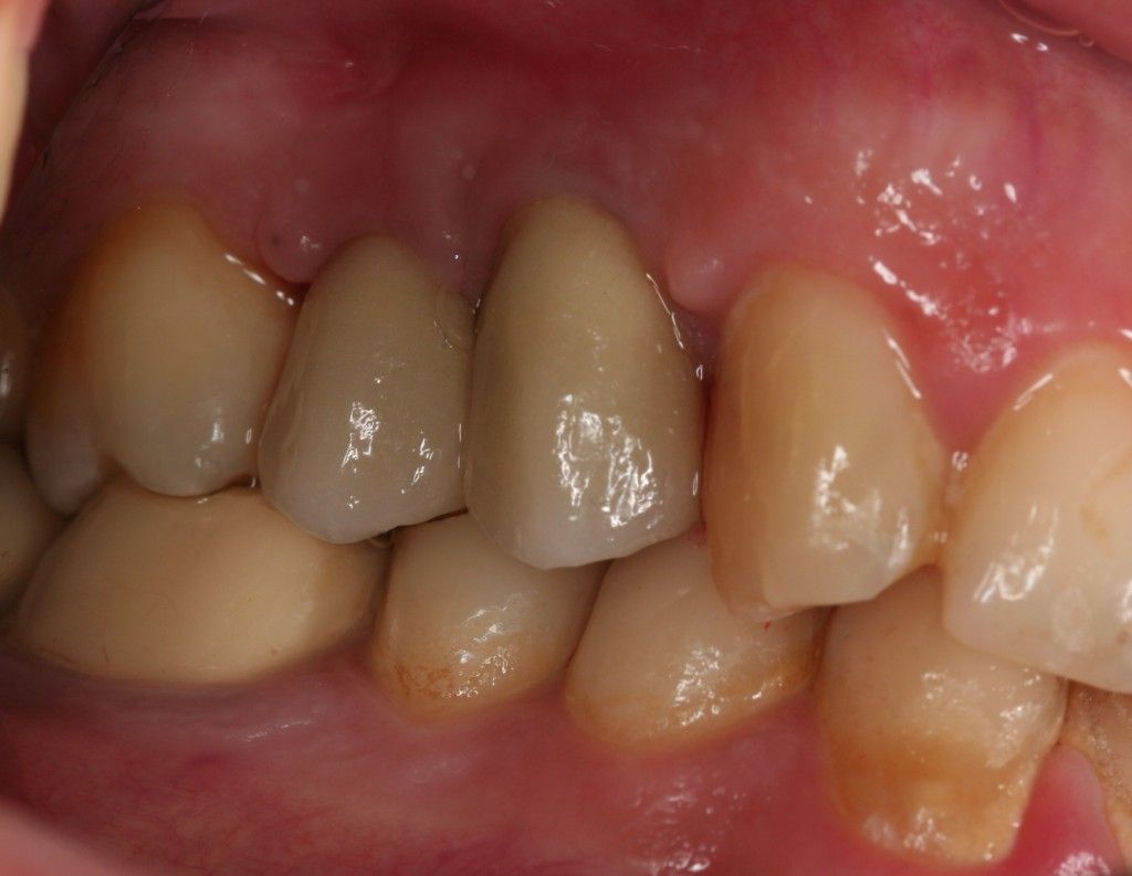 Implantes: Tratamientos de Centro Odontológico La Eliana Implantes: Tratamientos de Centro Odontológico La Eliana