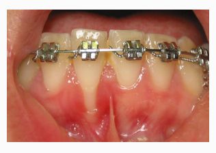 Injerto de tejido conectivo: Tratamientos de Centro Odontológico La Eliana Injerto de tejido conectivo: Tratamientos de Centro Odontológico La Eliana