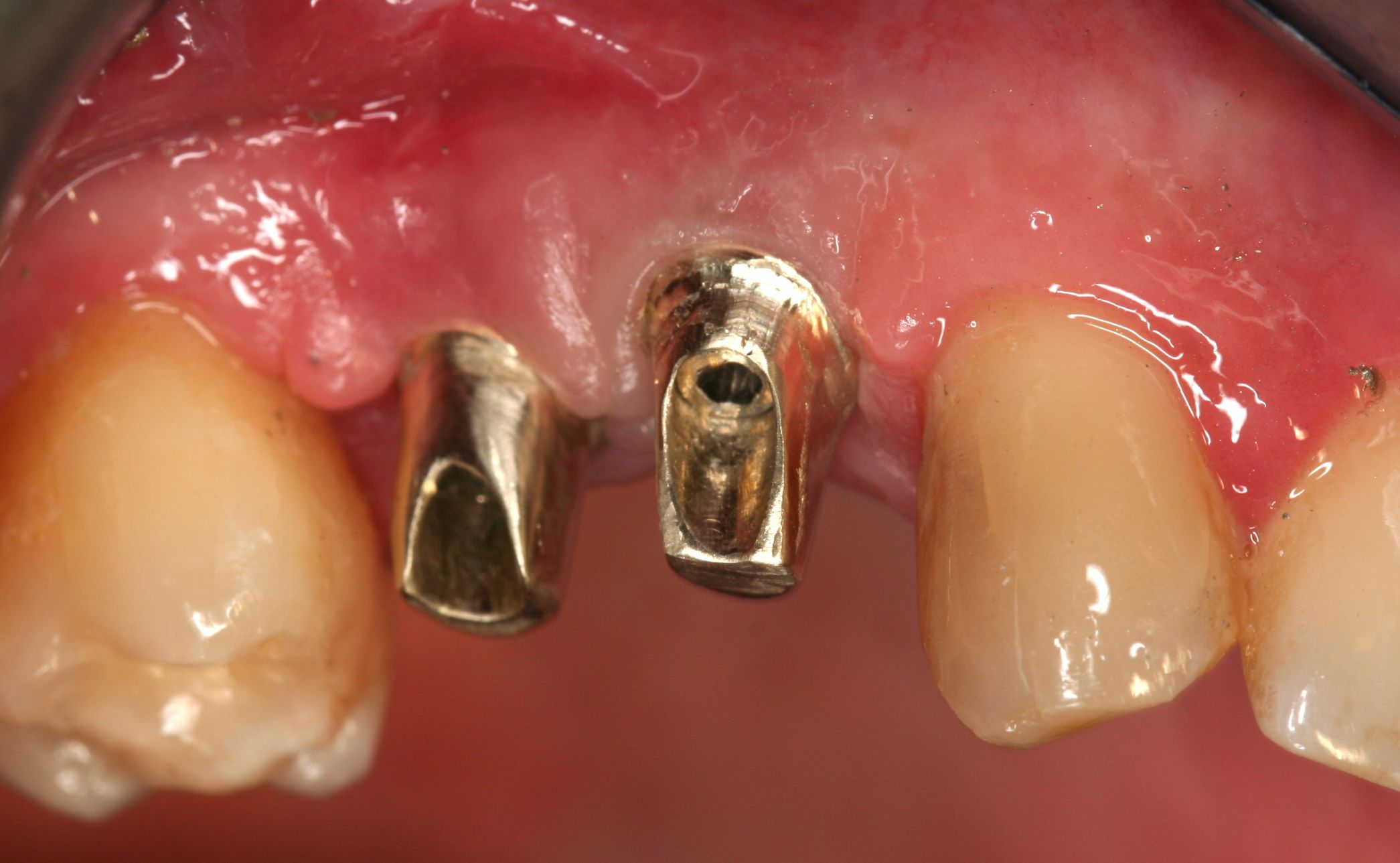 Implantes: Tratamientos de Centro Odontológico La Eliana Implantes: Tratamientos de Centro Odontológico La Eliana