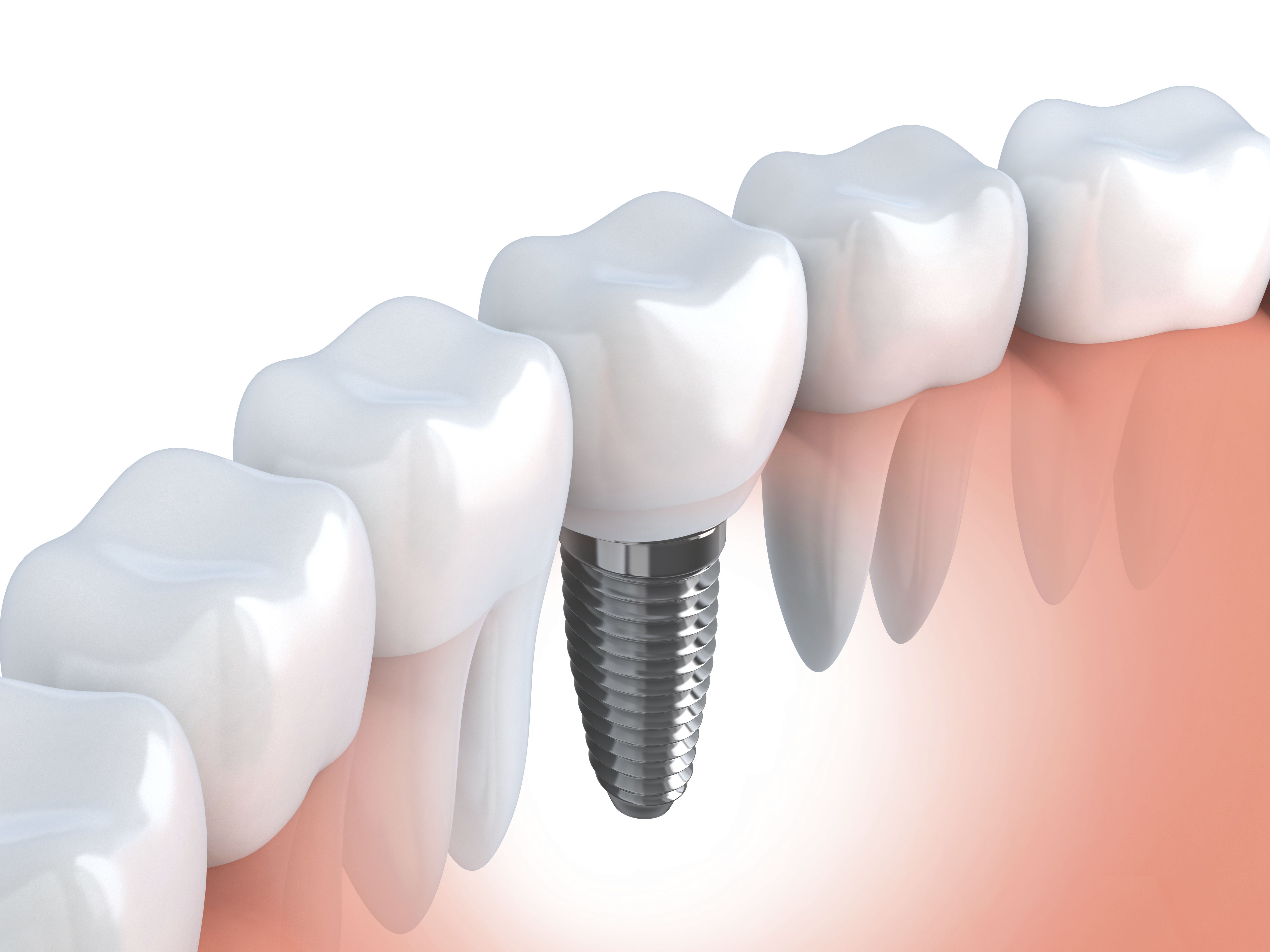 Implantes dentales: Especialidades odontológicas de Clínica Dental Gil