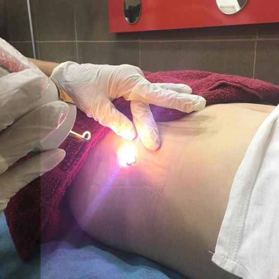 Laser: Trabajos de Ink Heart Tattoo Laser: Trabajos de Ink Heart Tattoo