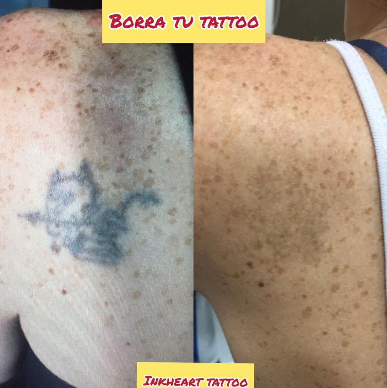 eliminacion tatuajes: Trabajos de Ink Heart Tattoo eliminacion tatuajes: Trabajos de Ink Heart Tattoo
