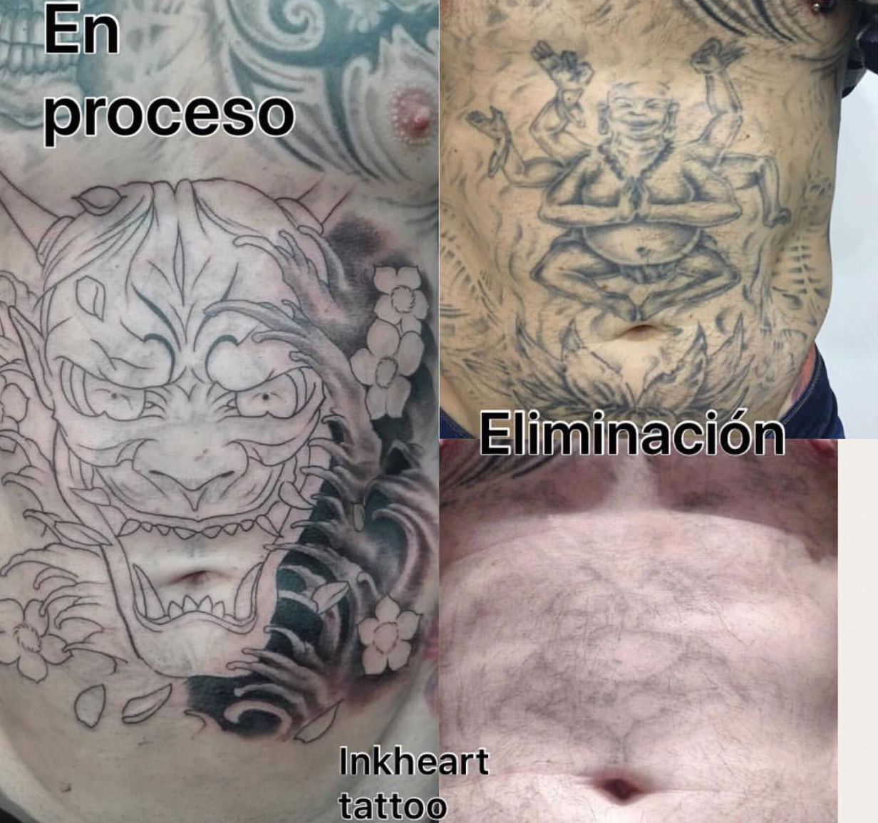 ELIMINACIÓN TATTOO ELIMINACIÓN TATTOO