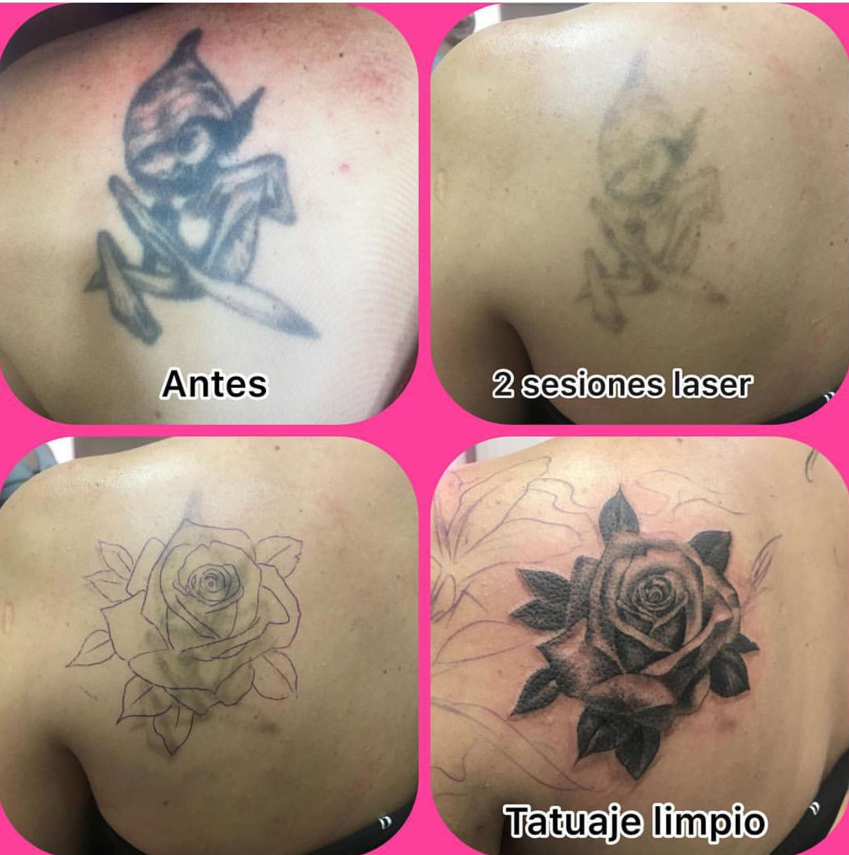 ELIMINACIÓN TATTOO ELIMINACIÓN TATTOO