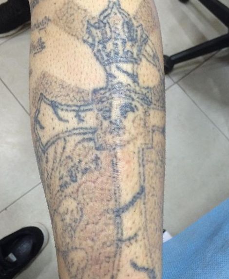 Laser: Trabajos de Ink Heart Tattoo Laser: Trabajos de Ink Heart Tattoo