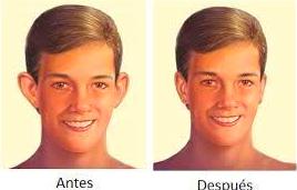 OTOPLASTIA: Nuestros tratamientos de Manzana 14 OTOPLASTIA: Nuestros tratamientos de Manzana 14