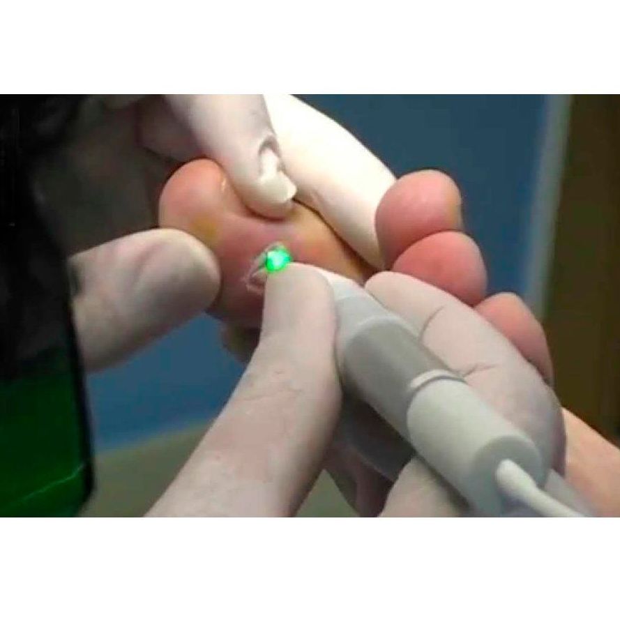 Papilomas: Servicios de Podonet Podología y Fisioterapia Papilomas: Servicios de Podonet Podología y Fisioterapia