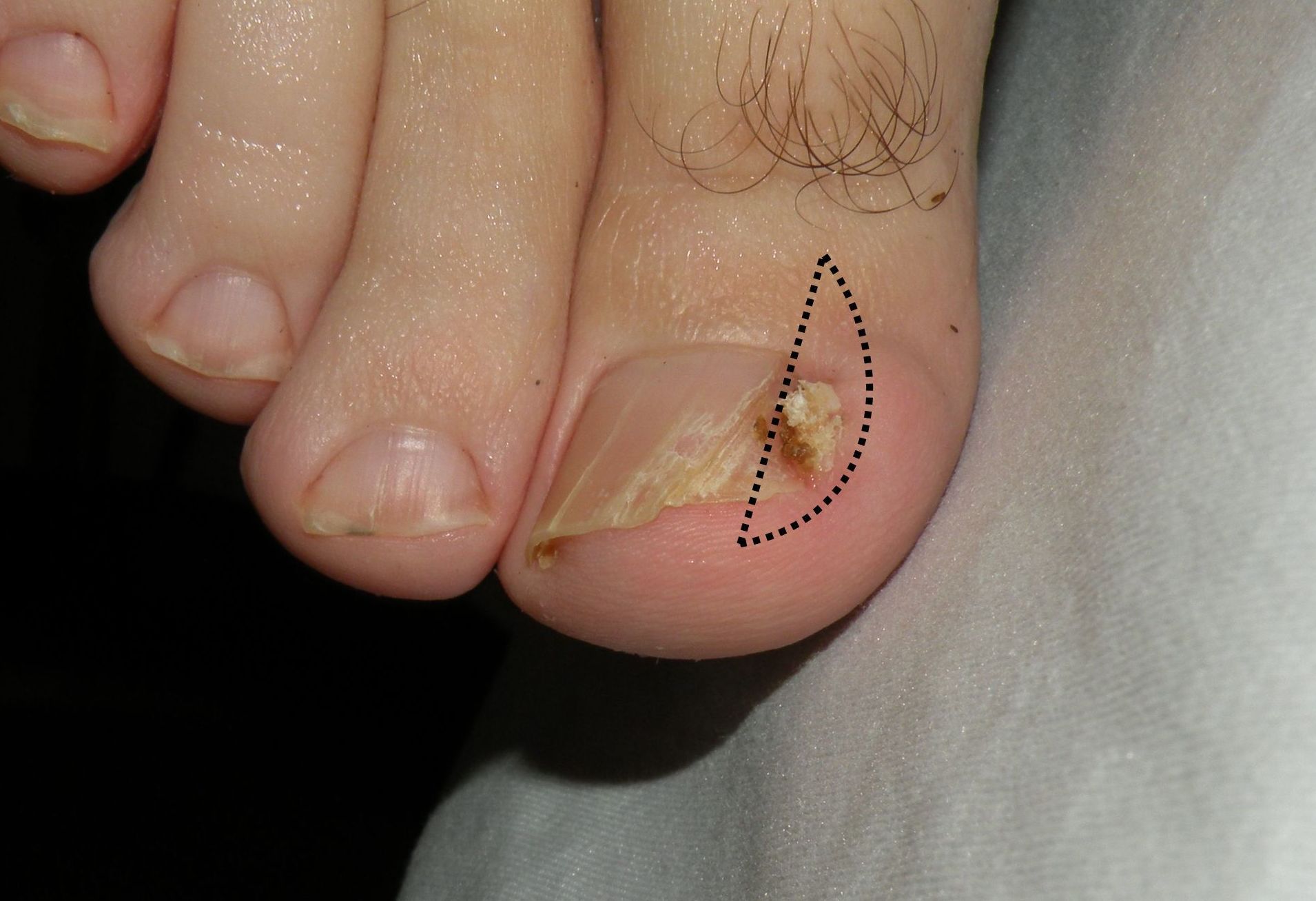 Uñas encarnadas: Servicios de Podonet Podología y Fisioterapia Uñas encarnadas: Servicios de Podonet Podología y Fisioterapia