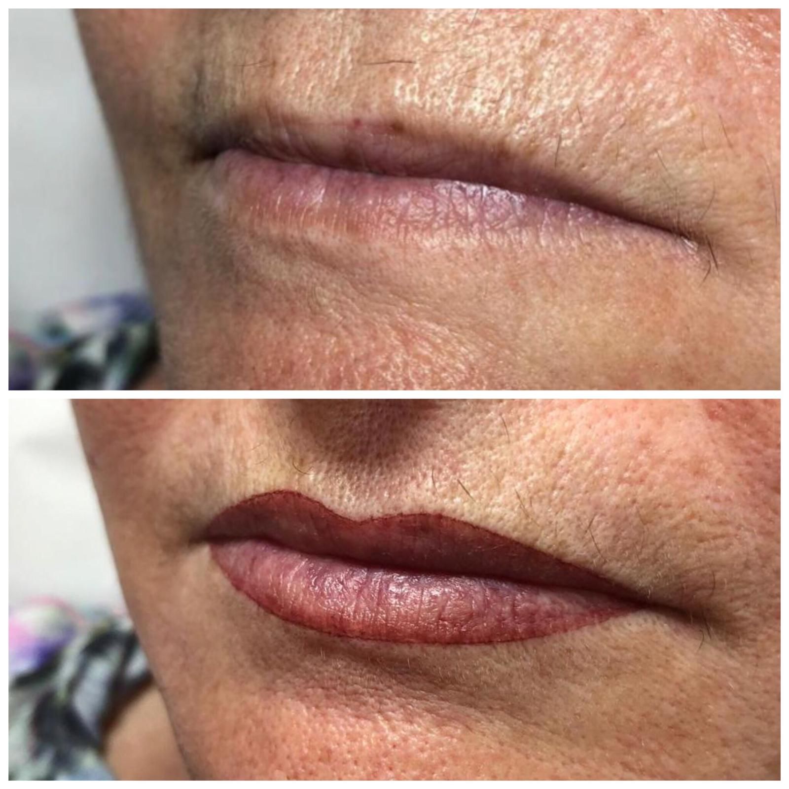 Micropigmentación Barcelona: Patologías y tratamientos de Centro Dermatológico Dr. Javier Bassas Micropigmentación Barcelona: Patologías y tratamientos de Centro Dermatológico Dr. Javier Bassas